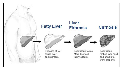 Stages of Liver Damage